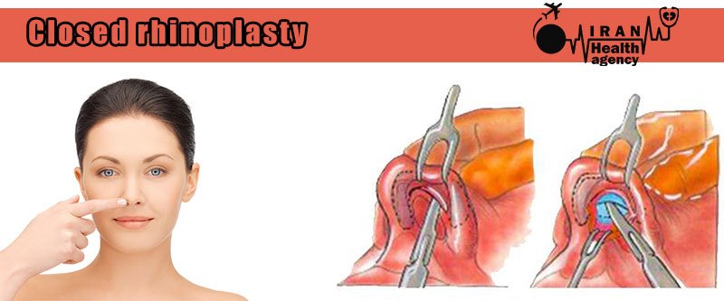 closed rhinoplasty