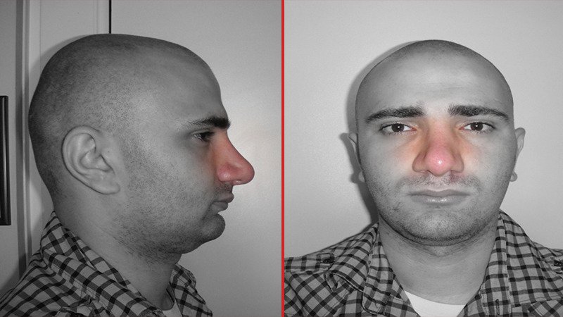 meaty Rhinoplasty