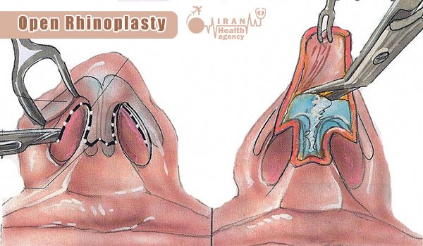 open Rhinoplasty