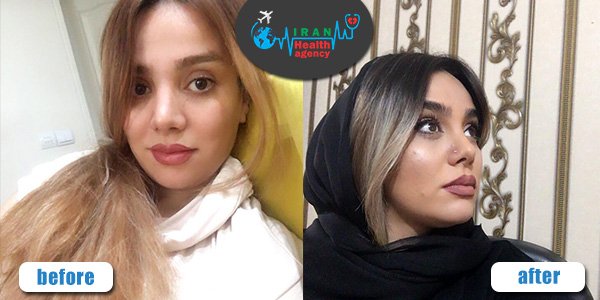 rhinoplasty before and after