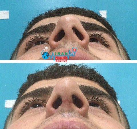 rhinoplasty in shiraz Iran before and after