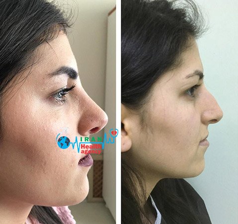 before and after of rhinoplasty in shiraz Iran