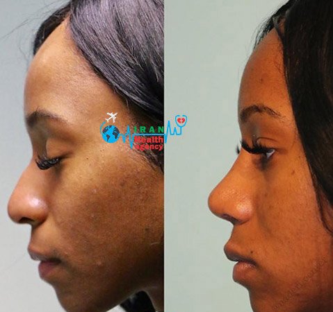 before and after of rhinoplasty in shiraz