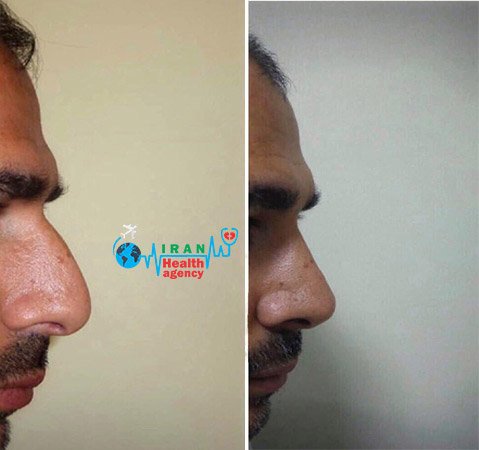 before and after of rhinoplasty in shiraz Iran