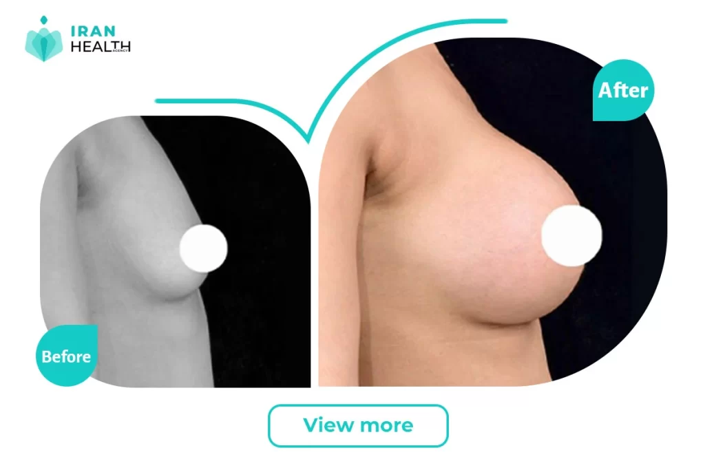 breast lift before after picture | iran health agency