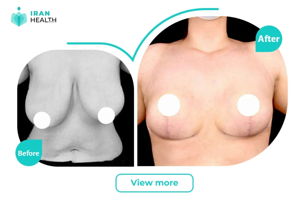 breast lift before after picture | iran health agency
