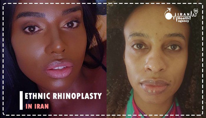Ethnic rhinoplasty in Iran