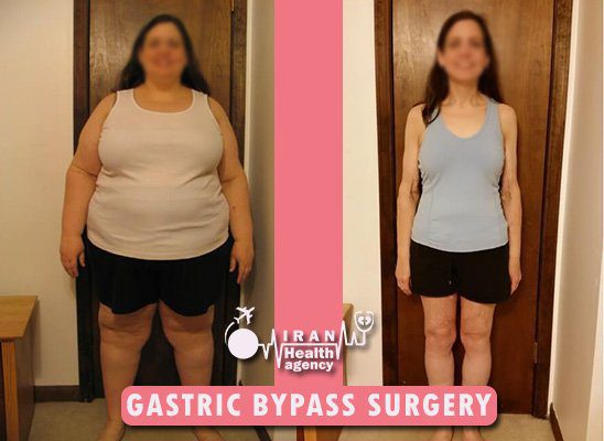 Results After Gastric Bypass Surgery Gastric Sleeve Surgery Weightwise Bariatric Program 6017