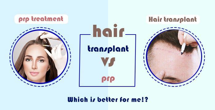 Which one is better? PRP or a Hair Transplant in Iran - Iran Health Agency