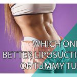 Which one is better liposuction or tummy tuck?