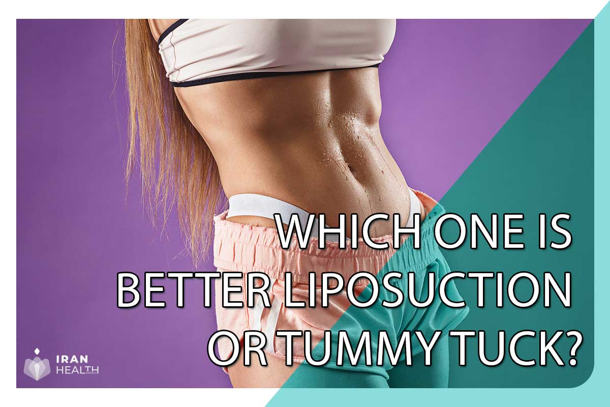 Which one is better liposuction or tummy tuck?