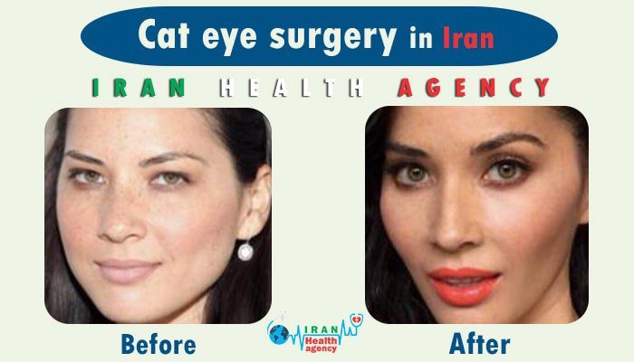 Canthoplasty Iran cat eye surgery in Iran ️ 2021 Cost