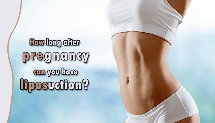 How long after pregnancy can you have liposuction
