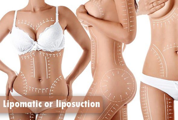 Lipomatic or liposuction