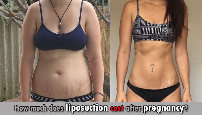 liposuction after pregnancy