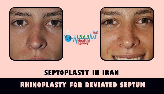 septoplasty before and after 1
