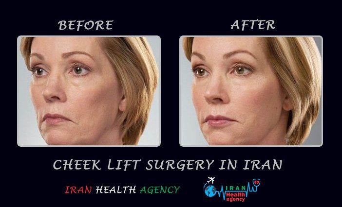 Cheek lift in Iran before and after