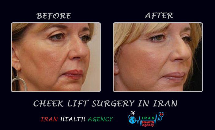 Cheek lift surgery Iran before and after