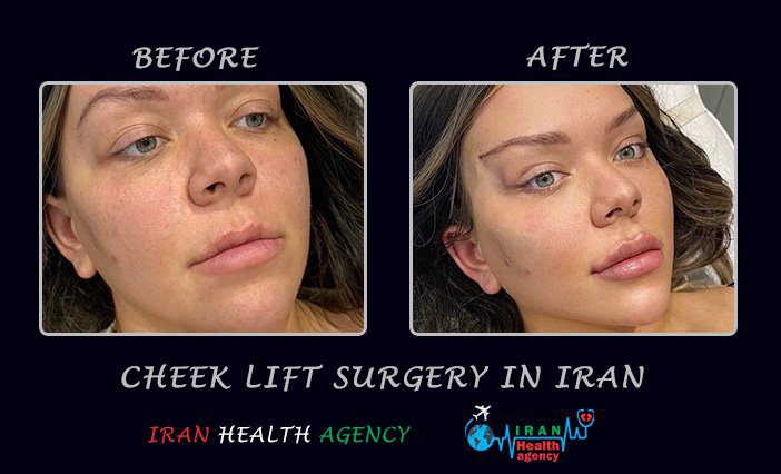 Cheek lift surgery before and after