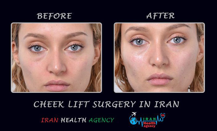 Cheek lift surgery in Iran before and after