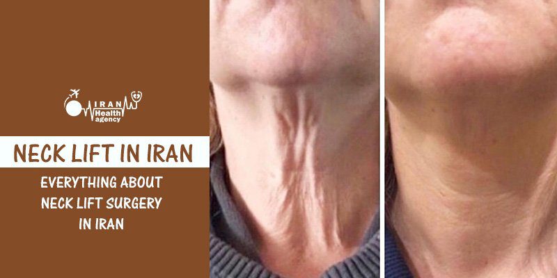 candidate for neck lift surgery in Iran