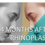 4 months after rhinoplasty, all you need to know 4 months after rhinoplasty, all you need to know
