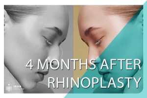 4 months after rhinoplasty