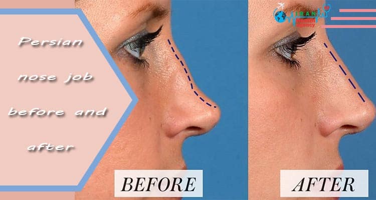Persian nose job before and after photos