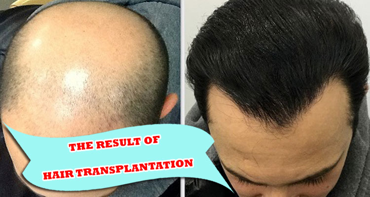 affecting the result of hair transplantation