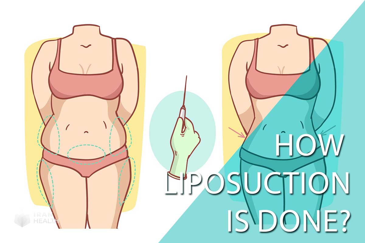 How liposuction is done?