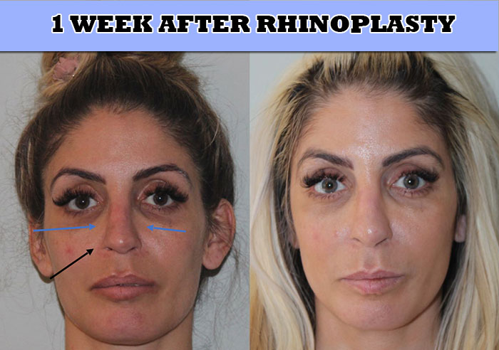rhinoplasty after one week