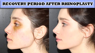 recovery nose after rhinoplasty