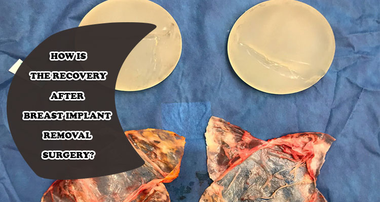 How is the recovery after breast implant removal surgery?