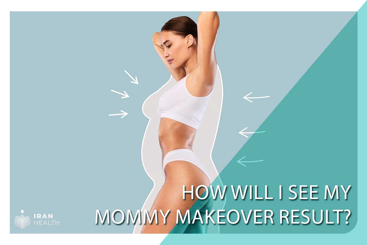 How will I see my mommy makeover result?