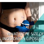 What is the size of the incisions in liposuction?