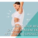 What kind of results should a patient expect after the 360 liposuction?