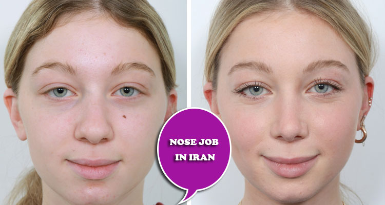 Important and influential factors on the outcome of nose job