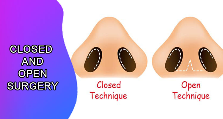 Rhinoplasty method: Closed and open surgery