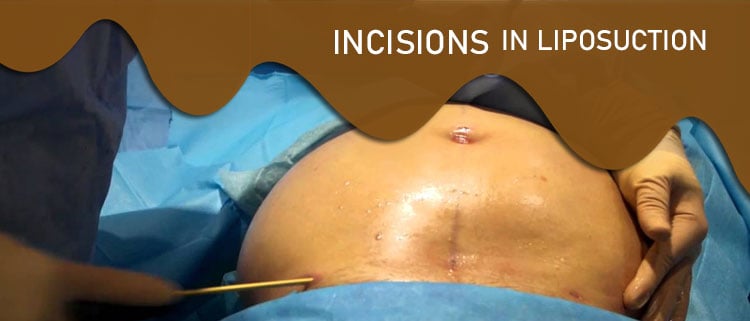 incisions in liposuction