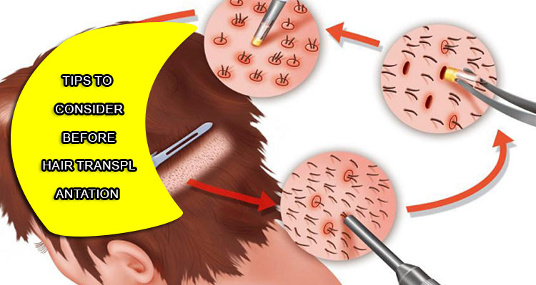 Tips to consider before hair transplantation