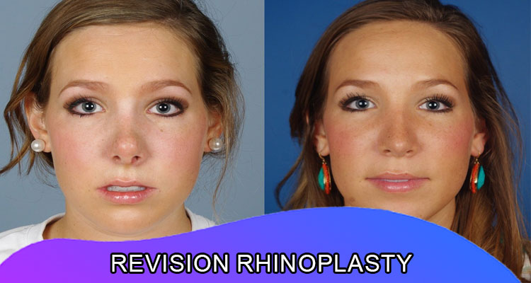 Revision rhinoplasty