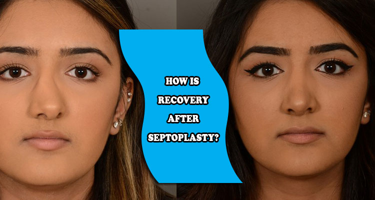 How is recovery after septoplasty?