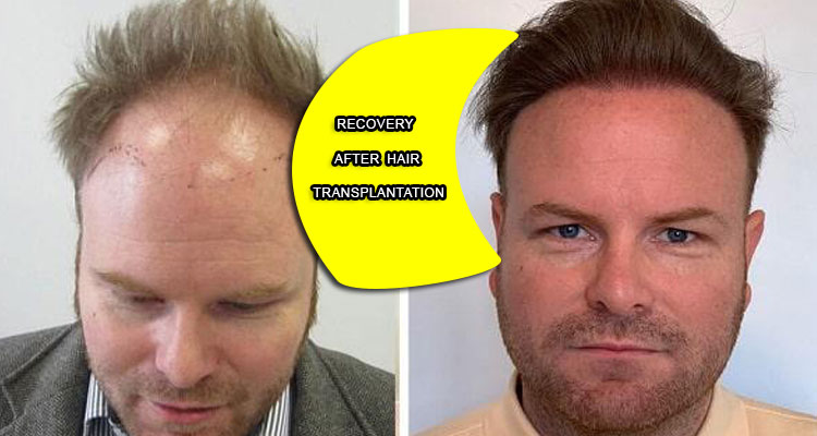 Recovery after hair transplantation