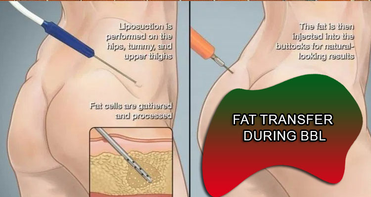 Fat transfer during BBL