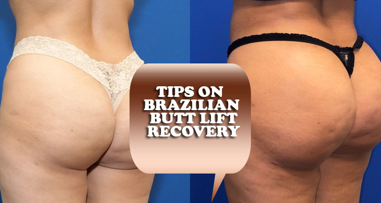 Tips on Brazilian Butt lift recovery