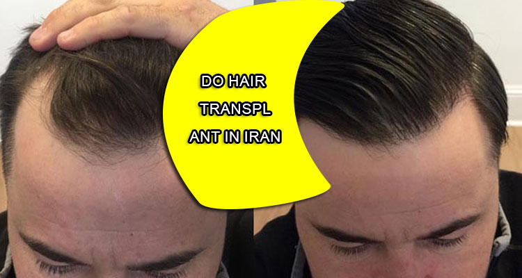 Do hair transplant in Iran
