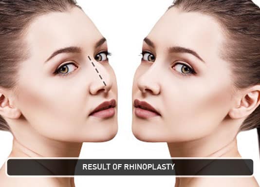 result of rhinoplasty