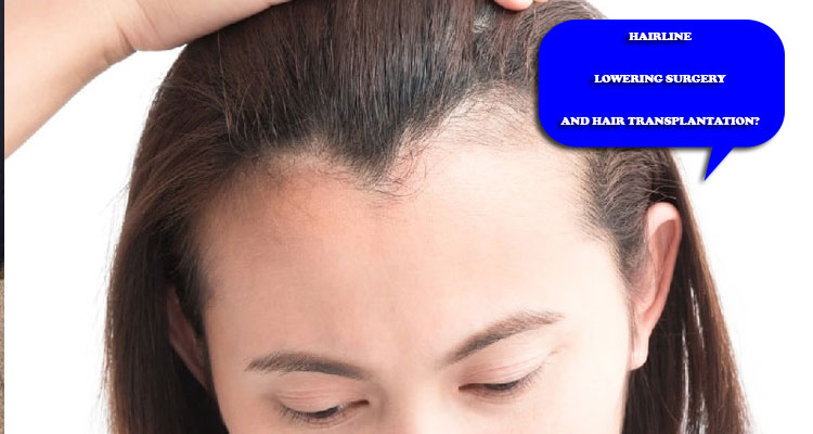 hairline lowering surgery and hair transplantation?