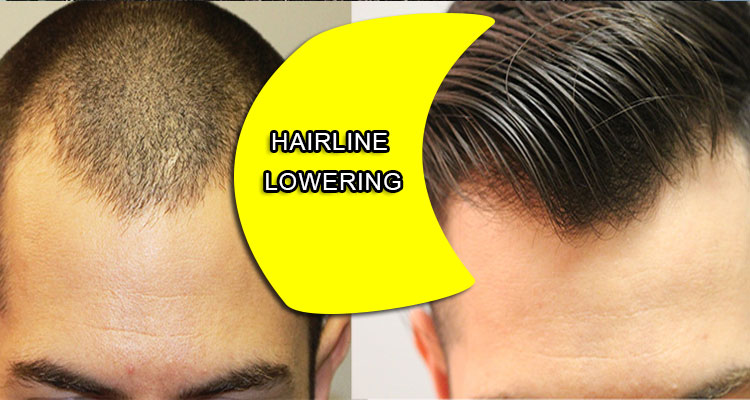 Hairline lowering