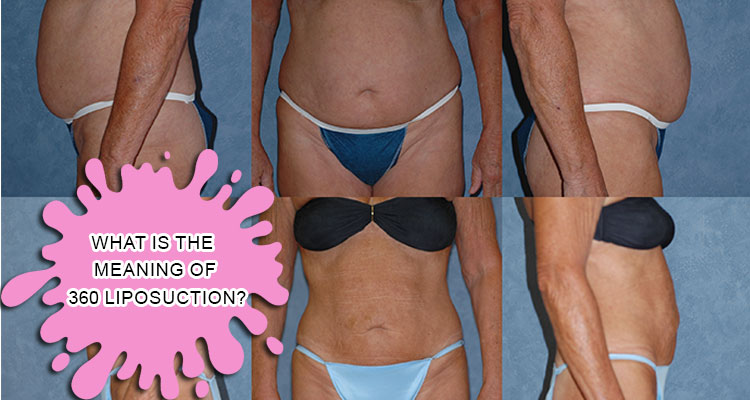 What is the meaning of 360 liposuction?